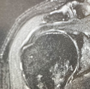インピンジメント症候群